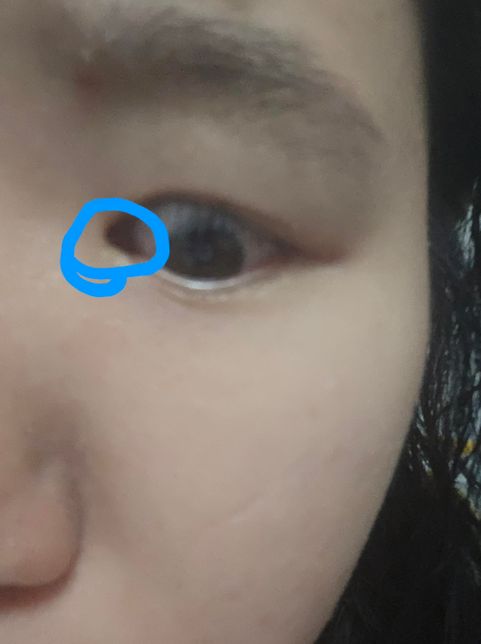 눈깜빡 일때마다ㅠㅠ아파요ㅠㅠㅠㅠ의 0번 째 이미지
