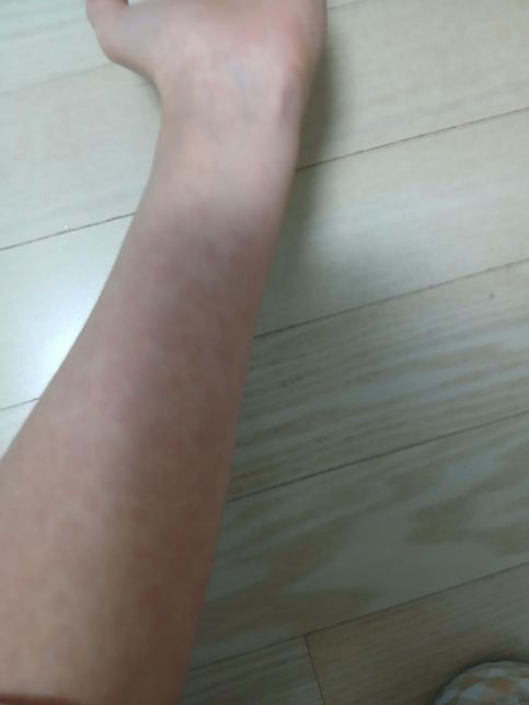 두드러기가 약을 먹었는데도 점점 심해져요의 1번 째 이미지