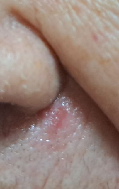 상처 새살 돋게 하는데 마데카솔이 효과가 있나요?의 0번 째 이미지