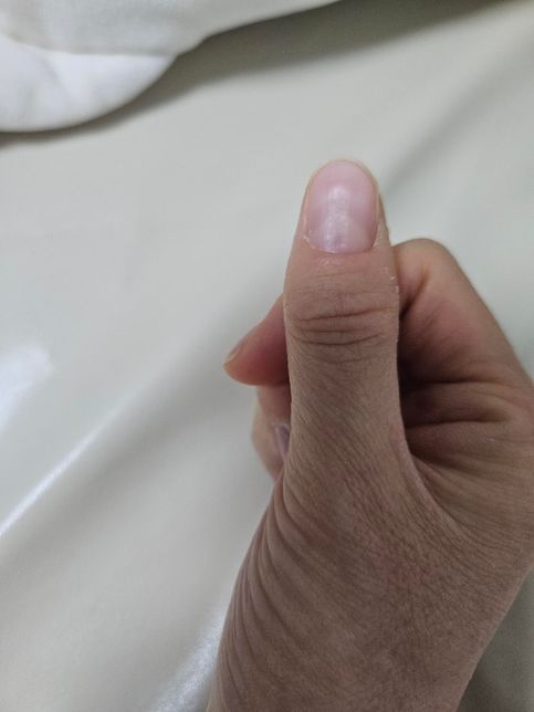 오른쪽엄지손톱 가운데 울퉁불퉁 합니의 0번 째 이미지