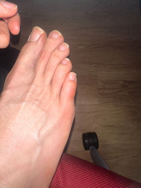 벌레에 물린거 같아요! 약 추천부탁드립니다.의 0번 째 이미지