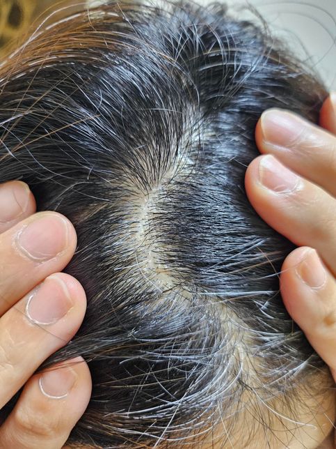 두피염 진균감염일경우 무조건 먹는진균제를 먹어야 낫나요?의 1번 째 이미지