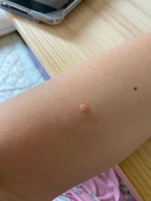 벌레에 물렸는데 며칠이 지나도 이 모양의 0번 째 이미지