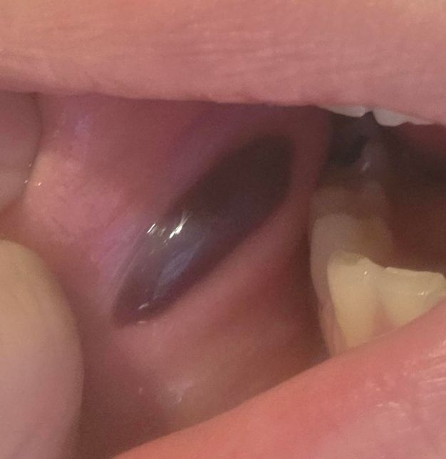 입안에 피고름이 생겼어요 ㅜㅜ 봐주세요 ㅜㅜ의 0번 째 이미지