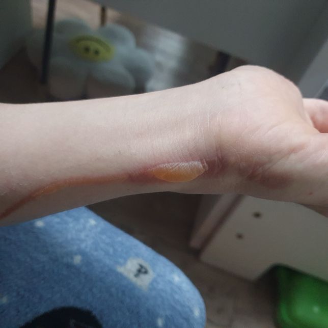 이런 화상 상처는 어떻게 해야하나요?의 0번 째 이미지