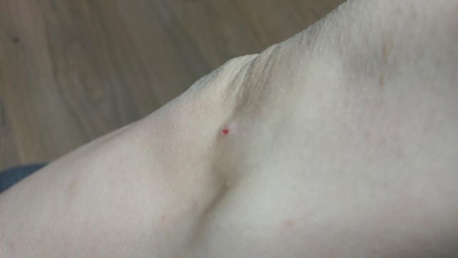 팔꿈치쪽에 타박상 상처 생겼는데 무슨 약 발라줘야 되나요?의 0번 째 이미지