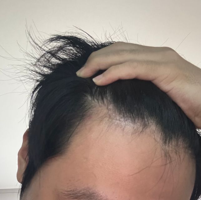 남자 고등학생 m자탈모가 맞는건가요??의 0번 째 이미지