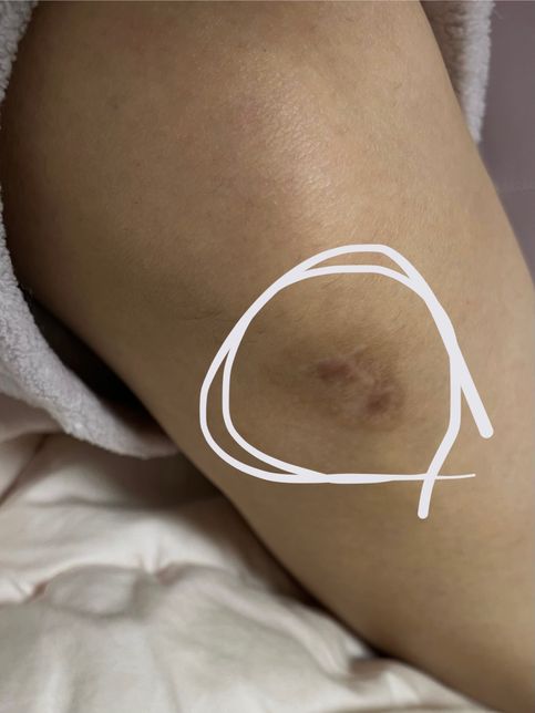 반년전에 생긴 아문 흉터자국 어떻게 없애나요??의 2번 째 이미지