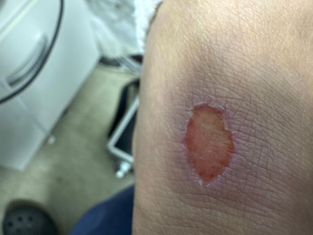 보험청구로 인한 화상 정도 문의드립니다.의 0번 째 이미지