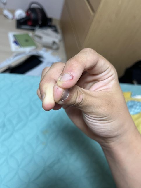 햄스터한테 물럈는데 괜찮나요..?의 0번 째 이미지