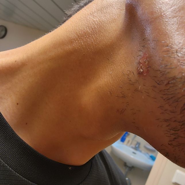 (긴급)2도 화상 자가치료에 대해 알려주세요의 0번 째 이미지