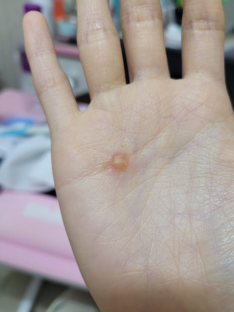 한의원 의료사고?2도화상 흉터에관한 배상책임의 0번 째 이미지