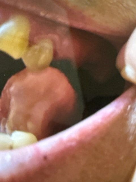 이빨이 자연스럽게 안 빠지면요. 며칠 있다가 치과 가야 돼요. 이거 자연스럽게 빠질 것 같 나요. 다른 사람들은요. 자연스럽게 안 빠지면 치과이의 0번 째 이미지