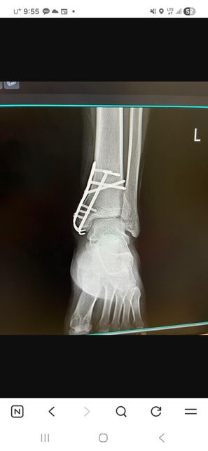 21년도 골절로 인한 후유장해 관련 질문의 1번 째 이미지