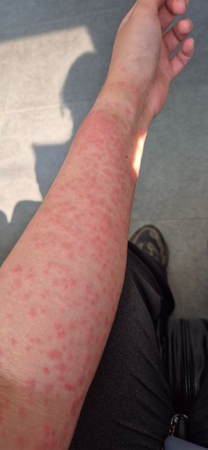 접촉성피부염 증상이 너무 심해요...주사 하루에 두번도 괜찮을까요?의 1번 째 이미지