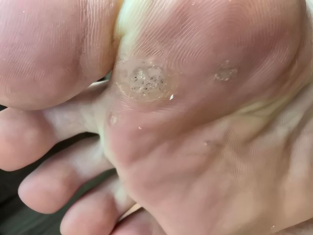 발바닥에 난 사마귀 제거 연고 추천해주셍요의 0번 째 이미지