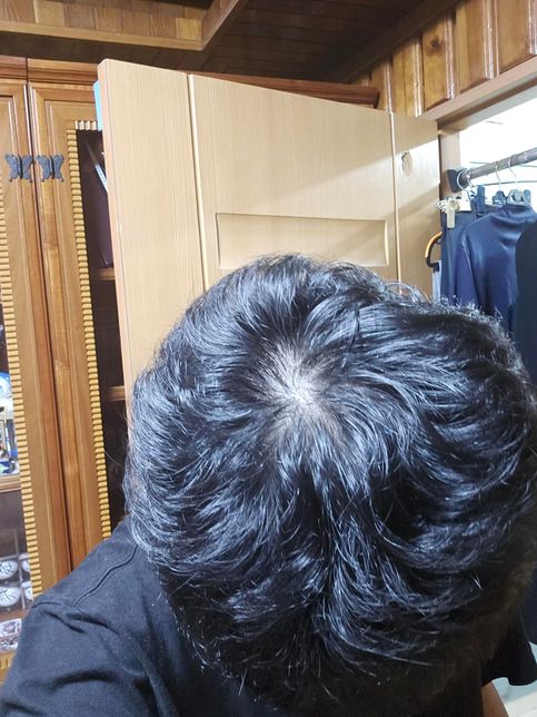 중학교 3학년 인데 정수리가 참... 도와주세요...의 2번 째 이미지