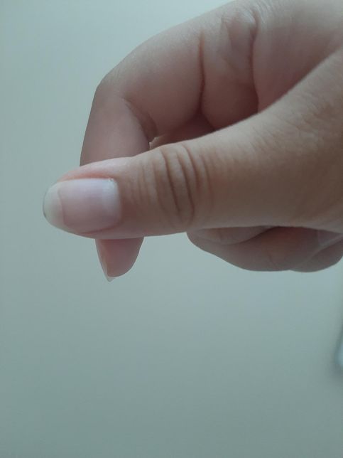 모양이 변형 된 손톱은 다시 돌아오나요?의 1번 째 이미지