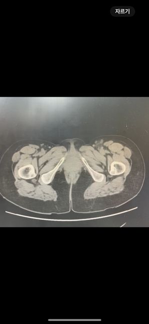 복부 ct 영상 판독부탁드립니다.!의 2번 째 이미지