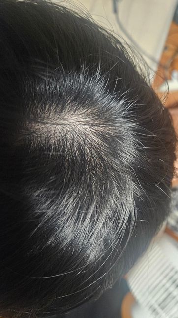 25세 남성 머리가 많이 빠지는데 탈모일까요?의 0번 째 이미지