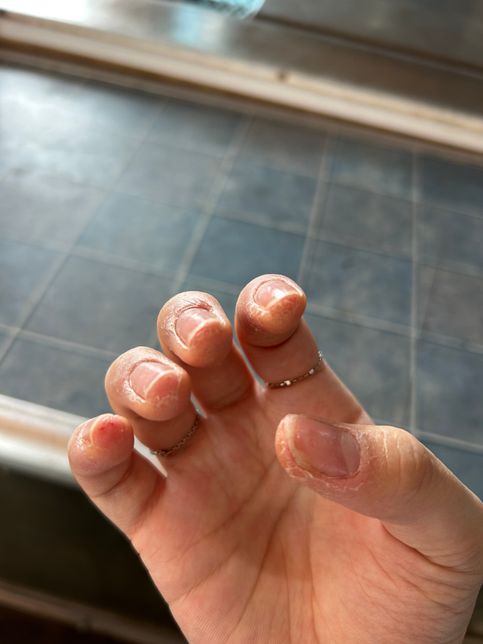 젤네일 알러지 때문잉가요 ˀ̣ 손가락 피부의 2번 째 이미지