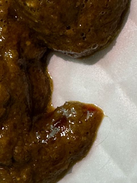 혹시 이거 혈변일까요???????의 0번 째 이미지