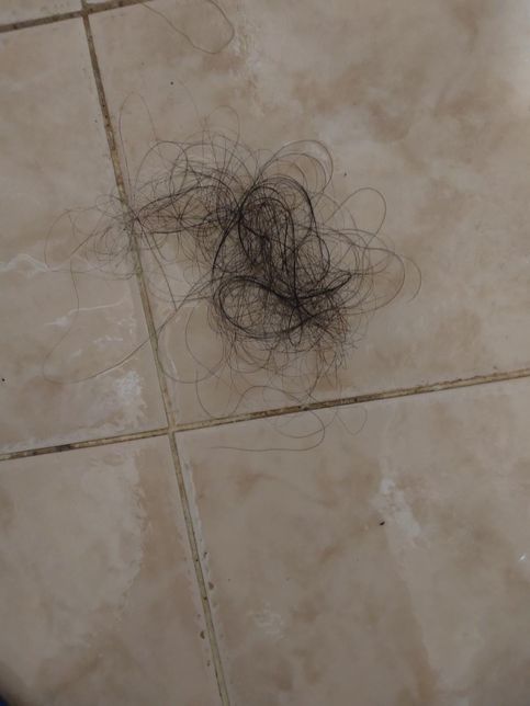 다이어트한약 장기간복용 후 탈모 부작용의 0번 째 이미지