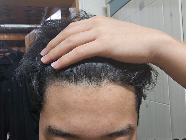 중학교 3학년 인데 정수리가 참... 도와주세요...의 0번 째 이미지