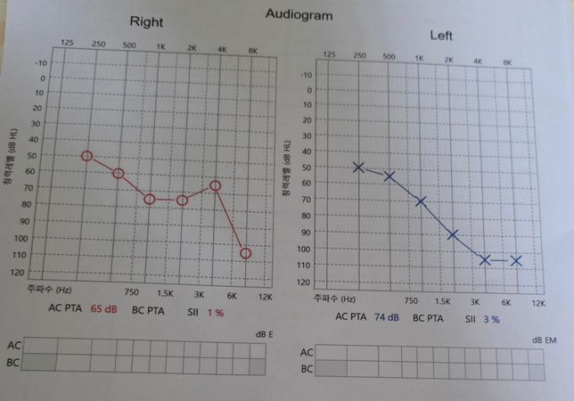 소음성난청 산재 가능여부 질문드립니다의 1번 째 이미지