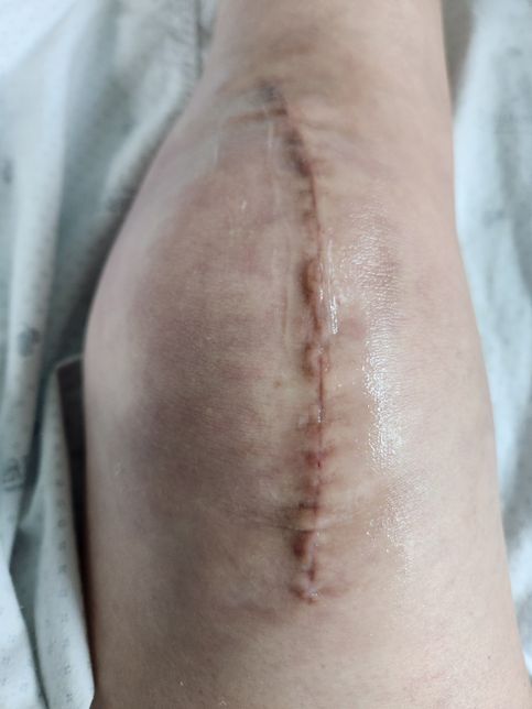 무릎 수술후 노스카나 바르면 원래 착색이 더 진해지나요?의 1번 째 이미지