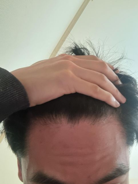 탈모약이랑 탈모 영양제 먹어도 머리가 빠질때의 0번 째 이미지