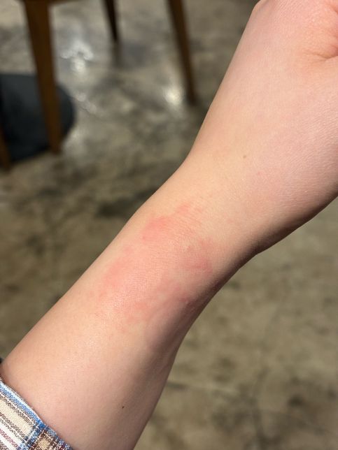 마취 주사 (혈관 터짐, 알러지반응) 의료 보상의 2번 째 이미지