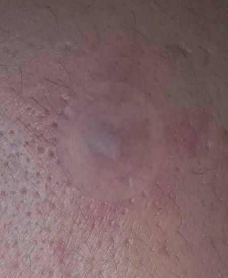 여드름 압출후 여드름패치 교체 궁금해요의 0번 째 이미지