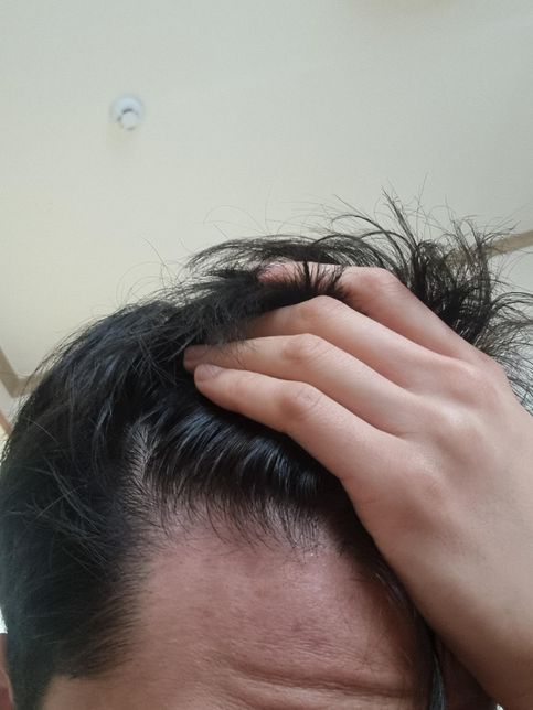 탈모약이랑 탈모 영양제 먹어도 머리가 빠질때의 1번 째 이미지