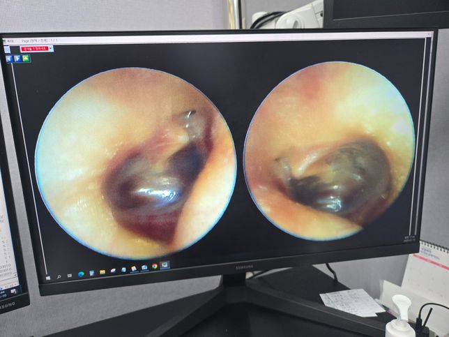 만성 중이염 관련해서........의 2번 째 이미지