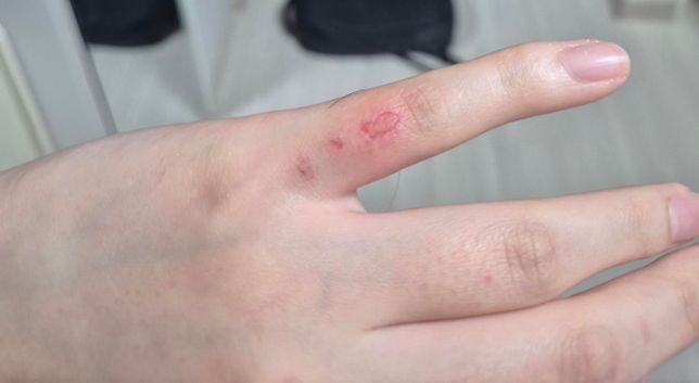 살이 까진 경우도 산재처리 가능할까요?의 1번 째 이미지