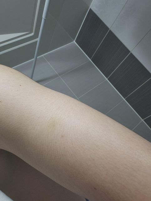 운동하고 팔이 노랗게 변했는데 멍든건가요?의 1번 째 이미지