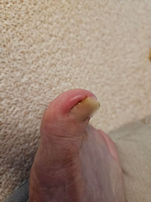 내성발톱때문에 엄지발가락 끝쪽 염증이 있는데여 첨부약중에 피디정과 펠루비정만 먹어도 되나요?의 0번 째 이미지