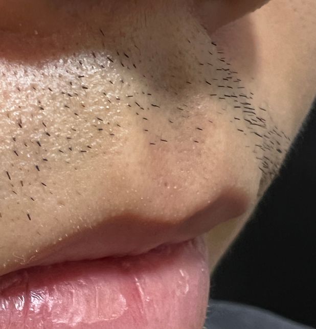 인중 여드름 흉터? 아니면 다른것 일까요의 1번 째 이미지