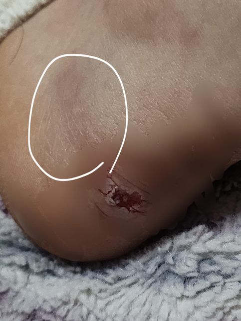 상처 관리법(?)(어제 질문했었던 사람이에요)의 0번 째 이미지