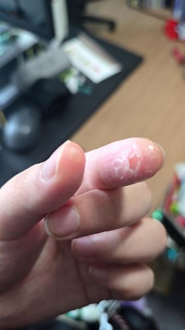순간접착제가 손가락에 들이부어져서 살이 화상입은거같아용의 1번 째 이미지