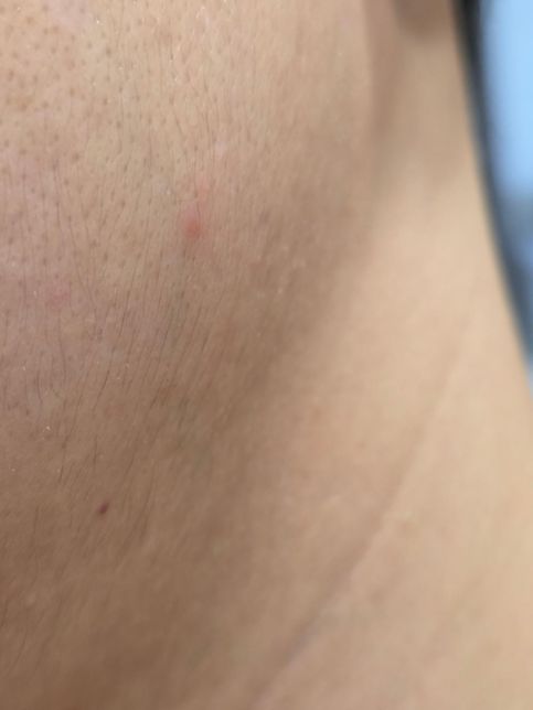 빨갛고 부은곳에 어떤 연고를 바르는게 좋은가요?의 0번 째 이미지