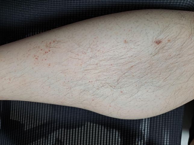 아래 피부발진은 약물부작용으로 인한 것인가요?의 1번 째 이미지