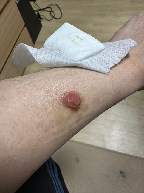 피부과에서 의료사고로 심재성 2도 화상 피해 보상 얼마 청구 해야할까요 ?의 2번 째 이미지
