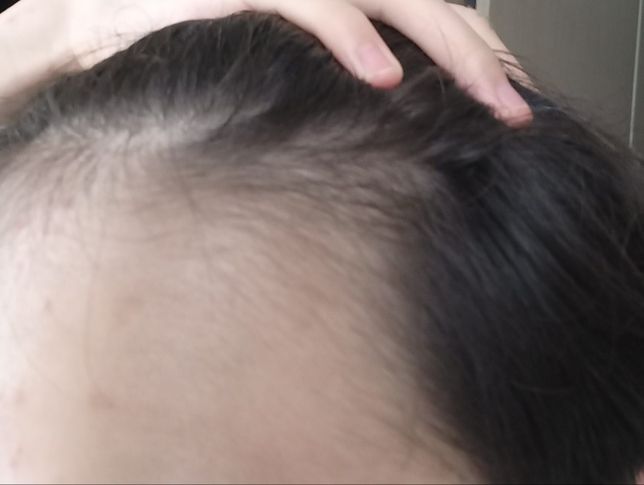 중학교2학년인데 혹시 이거 탈모증상인가요?의 2번 째 이미지