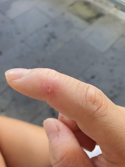 강아지가 실수로 살짝 물었는데 피가 아주 조금났어요. 조치가 필요한가요?의 0번 째 이미지