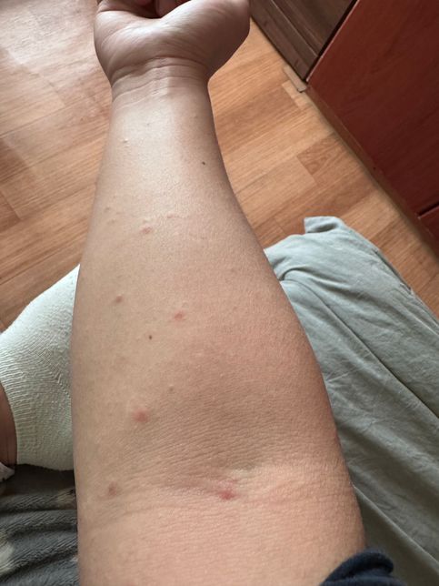 등과 가슴에 붉은 반점이 생겼습니다.의 0번 째 이미지