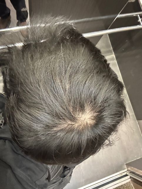 원형 탈모인가요? 탈모 초기맞을까요?!의 1번 째 이미지