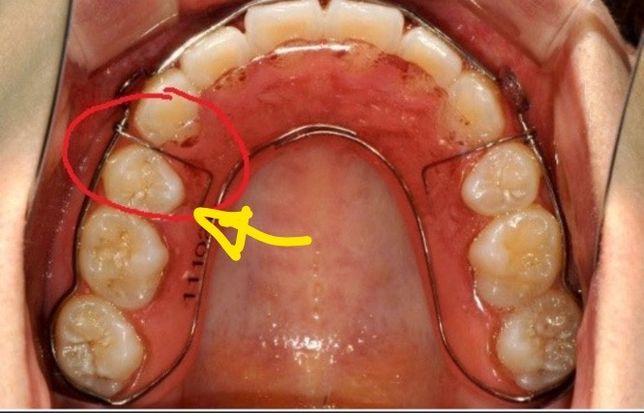 가철식유지장치 틈이 생겨버렸어요 ㅠㅜ의 0번 째 이미지