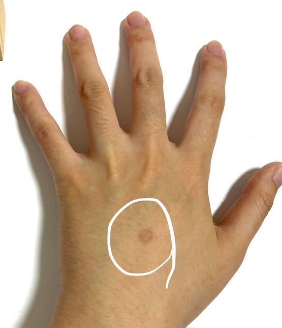 반년전에 생긴 아문 흉터자국 어떻게 없애나요??의 1번 째 이미지